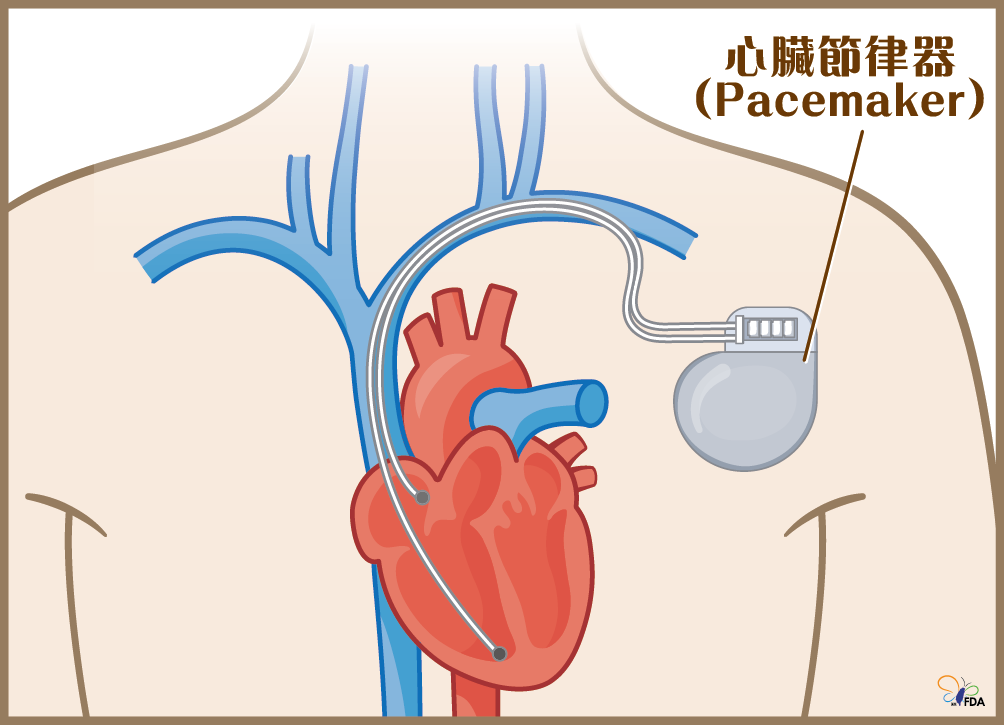 心臟節律器：調控心跳的重要醫療器材-圖片1