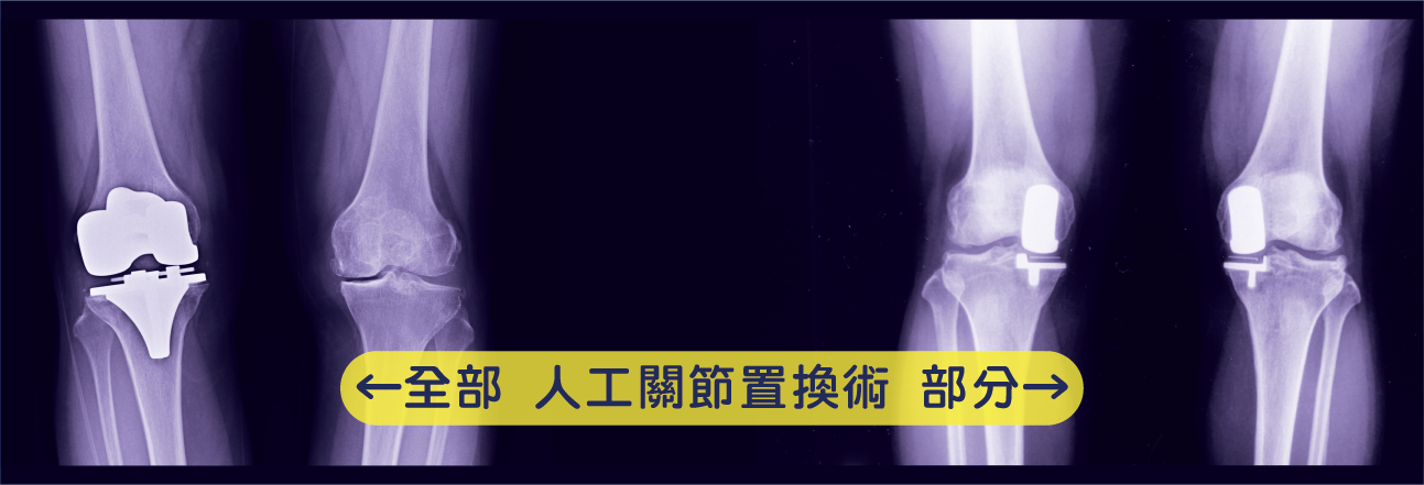 依據關節耗損程度，進行全部或部分人工膝關節置換術