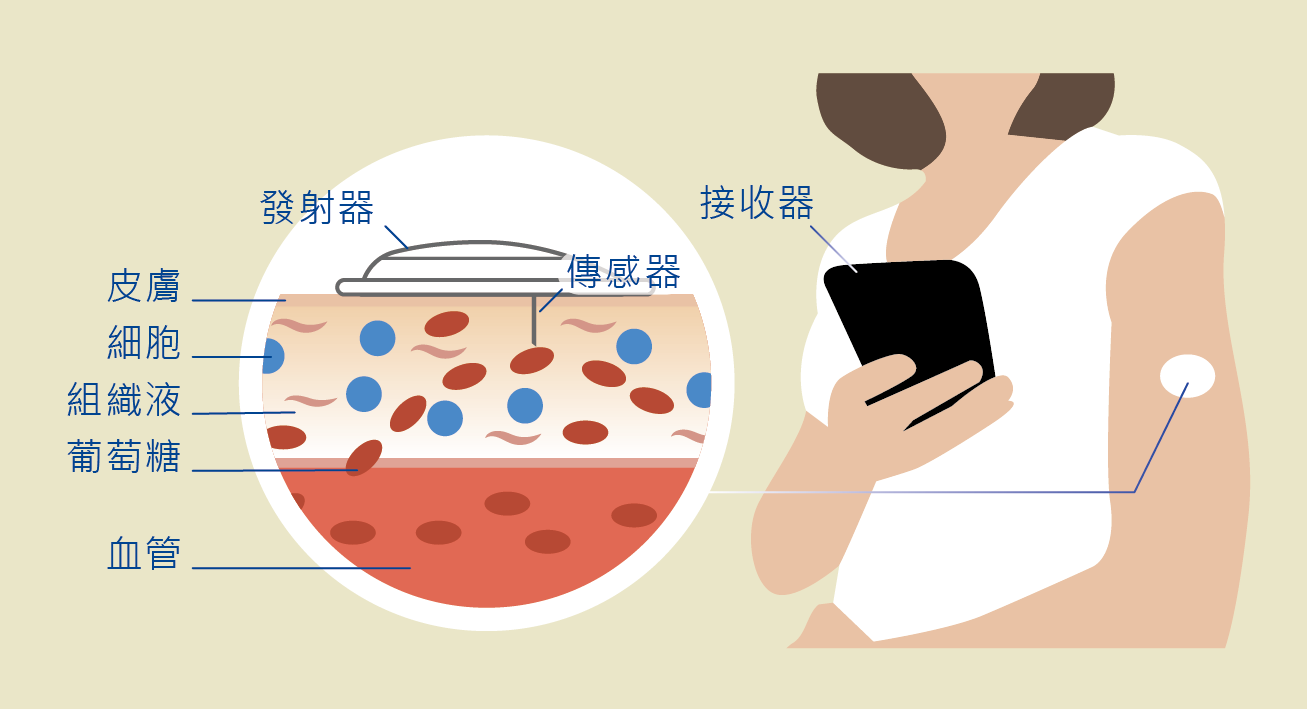 連續血糖監測系統,幫助糖友如常生活!