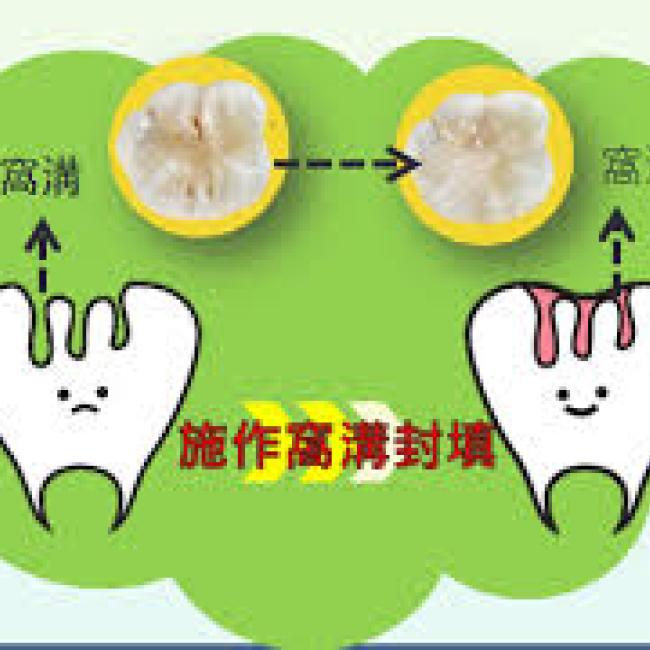 預防蛀牙新主張~兒童「臼齒窩溝封填」 窩溝封填