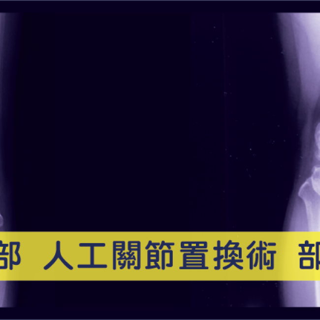 依據關節耗損程度，進行全部或部分人工膝關節置換術