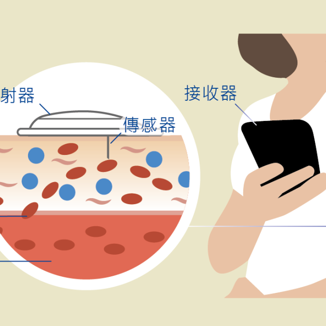 連續血糖監測系統,幫助糖友如常生活!