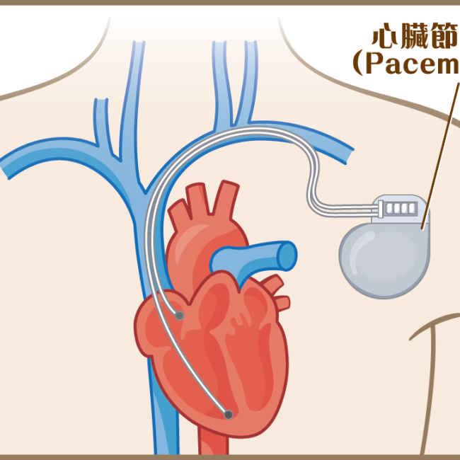 心臟節律器：調控心跳的重要醫療器材